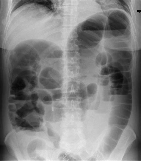 Ileus – Undergraduate Diagnostic Imaging Fundamentals