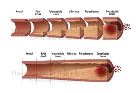 Atherosclerosis stages | HADERER & MULLER