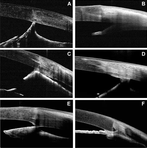 Types of anterior synechiae following penetrating keratoplasty in cases ...