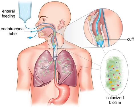 Endotracheal Tube In Patient