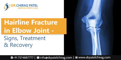 Hairline Fractures in Elbow Joint | Treatment & Recovery