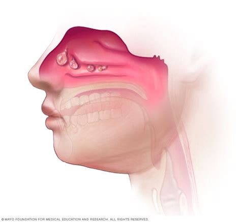 Chronic sinusitis - Symptoms and causes - Mayo Clinic