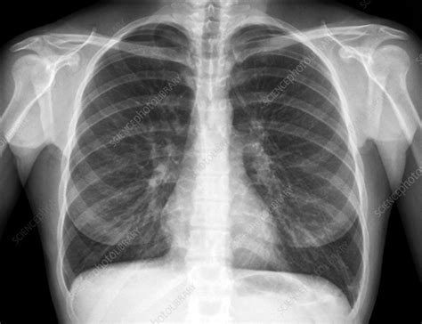 Healthy lungs, X-ray - Stock Image C009/6770 - Science Photo Library