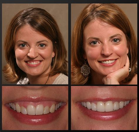 Laser Gum Treatment Rochester, MI | Swollen, Red Gums