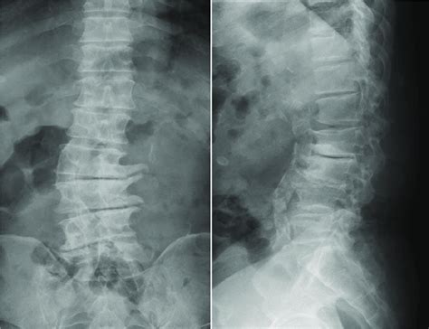 X-ray shows degenerative scoliosis in lumbar spine. | Download ...