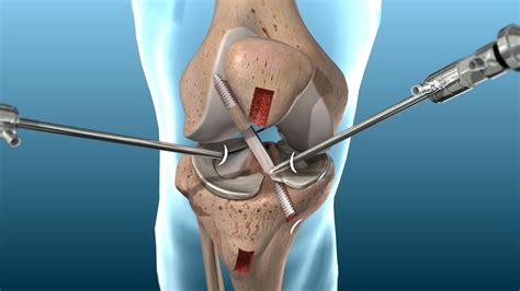 Knee Ligament Surgeries | Aptiva Health