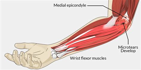 Golfer’s Elbow - The Complete Injury Guide - Vive Health