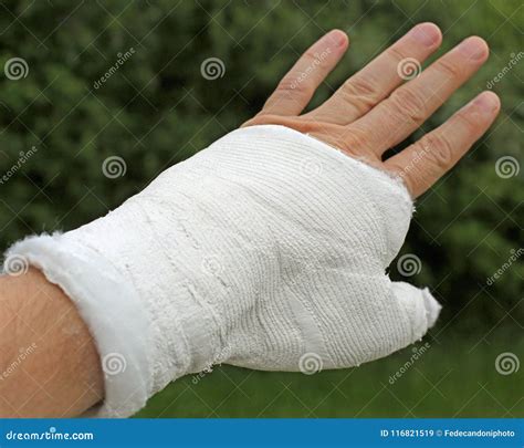 Broken Hand with the White Medical Cast after the Fracture of Th Stock ...