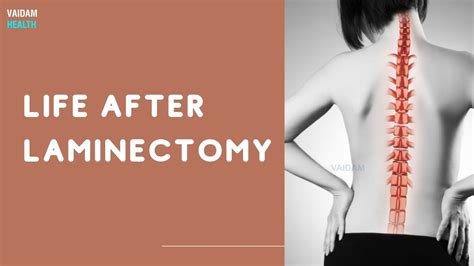 Life After Laminectomy - YouTube