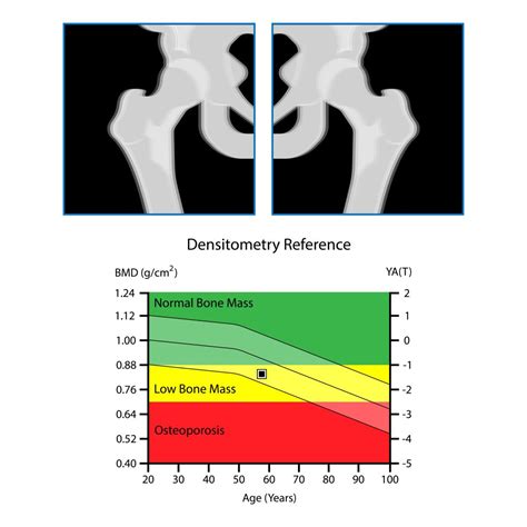 Osteoporosis - My Family Physio