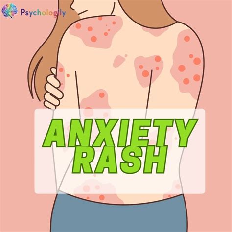 Anxiety Rash: Understanding the Link Between Stress and Skin Irritation ...