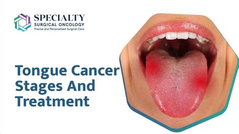 Tongue Cancer Stages And Treatment- SSO Hospital