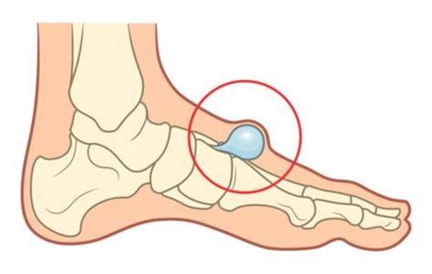 Do you have a Bump on Top of the Foot? [Hard, Painful or Bone Bump]