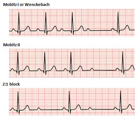 Second-degree atrioventricular block - Wikipedia