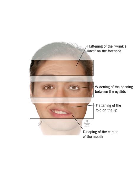 Everything about Bell’s Palsy | News | Dentagama