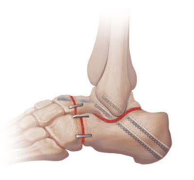 Arthrex - Triple Arthrodesis