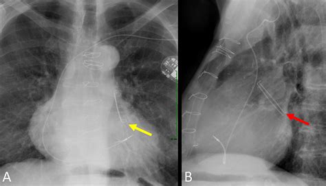 Amulet Left Atrial Appendage Closure Device