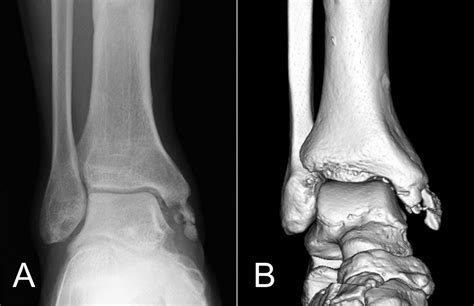 Proximal avulsion rupture of the flexor digitorum longus tendon ...