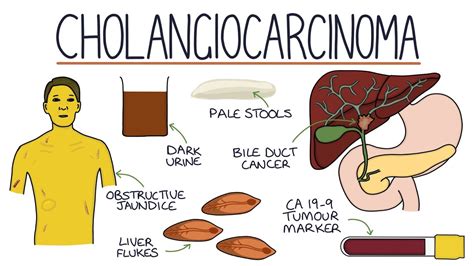 Understanding Cholangiocarcinoma - YouTube