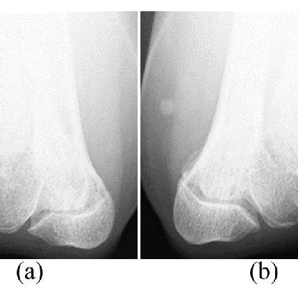 Axial view of computed tomography showing hypoplasia of the ulnar nerve ...