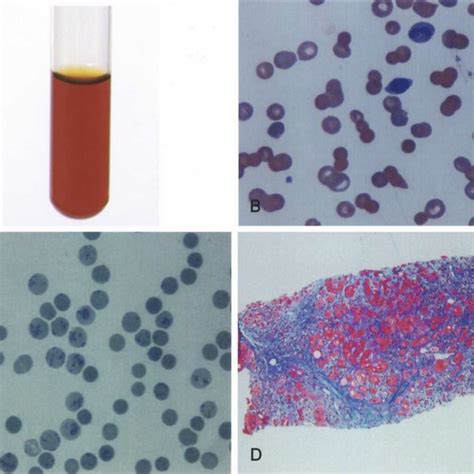 Panel A: patient’s serum shows hemolysis on the admission day; Panel B ...