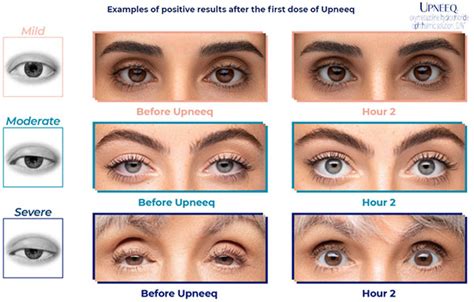 Droopy Eyelids Getting in the Way? | Vision Care Associates