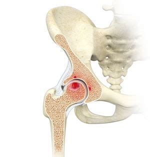 Femoral Subchondral Cysts Nassau County, Long Island, NY | Rheumatoid ...