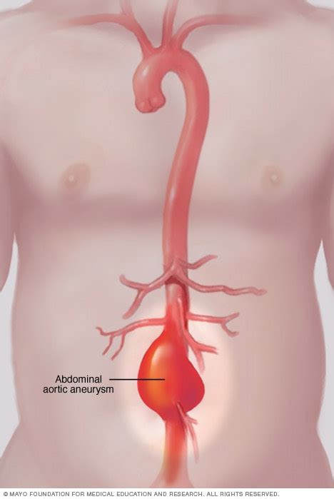 Abdominal aortic aneurysm - Symptoms and causes - Mayo Clinic