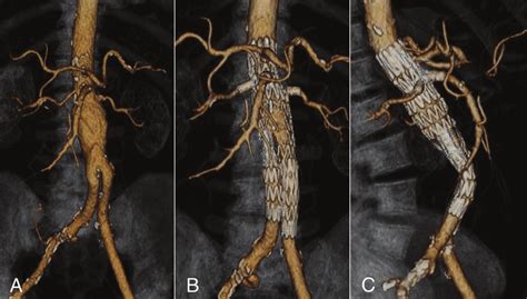 A, Volume rendered image of arterial-phase CT showing a juxtarenal ...