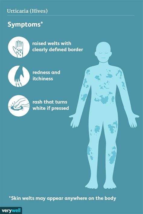 Urticaria (Hives): Signs, Symptoms, and Complications