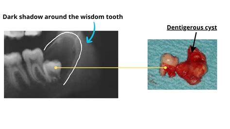 Wisdom Tooth Cyst: A Potential Complication Explained