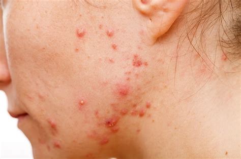 What Causes Acne Pustules? How to Get Rid of Them? – Derma Drink