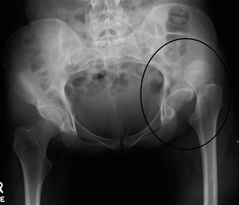 Hip Dislocation - Physiopedia