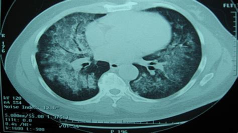 Diffuse alveolar hemorrhage triad speakers