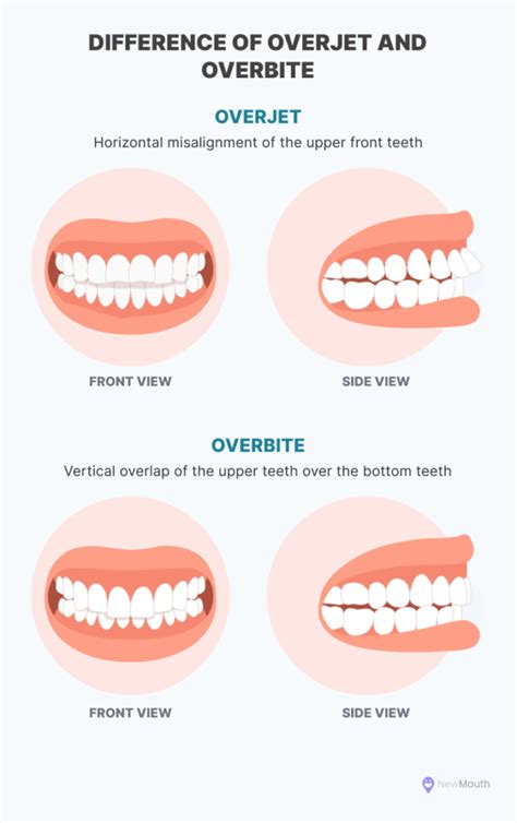 5 Common Overbite Treatment Options - NewMouth