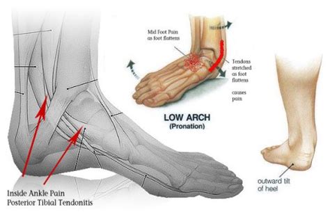 Foot Pain Under Ankle - The Complete Diagnosis and Treatment Guide!