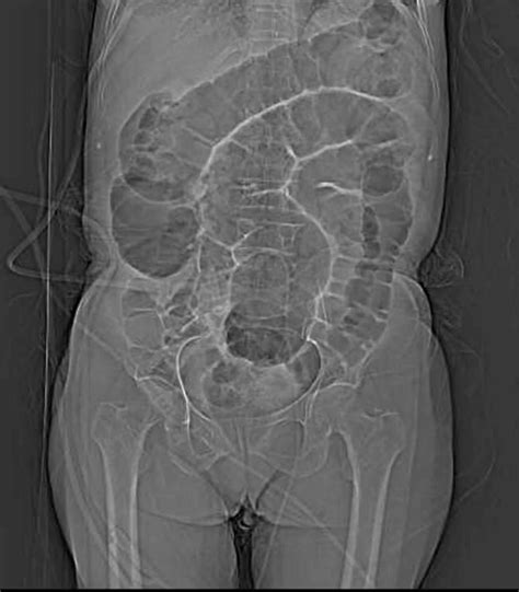 Intestinal ileus or paralytic ileus causes, symptoms, diagnosis & treatment