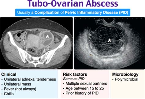 Tubo Ovarian Abscess On Ultrasound