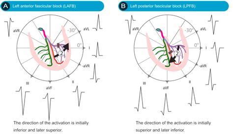 Fascicular block (hemiblock): Left anterior & left posterior fascicular ...