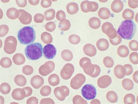 Medical Pictures Info – Acute Lymphoblastic Leukemia