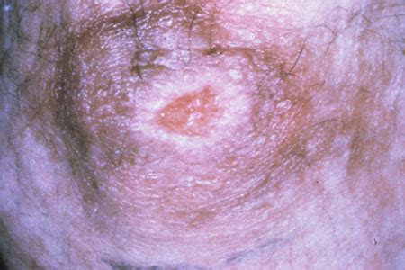 HIV/AIDS Dermatological Images - HIV