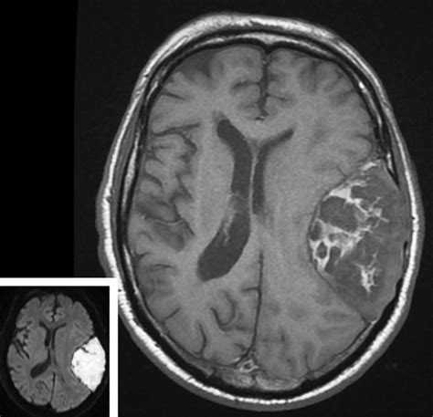 A tight squeeze with an intracranial epidermoid brain tumour - The Lancet