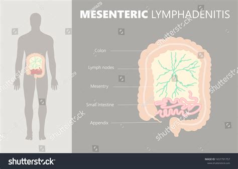 Medical Illustration Mesenteric Lymphadenitis By Inflamed Stock ...