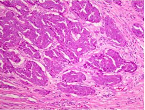 FULL TEXT - Neuroendocrine tumor of the breast: Is it primary or ...