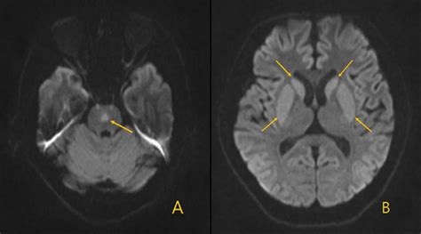 Central pontine myelinolysis, causes, symptoms, diagnosis, treatment ...