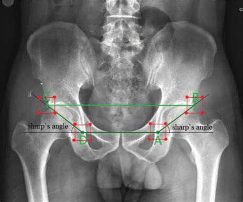 [DIAGRAM] X Ray Pelvis Diagram - MYDIAGRAM.ONLINE