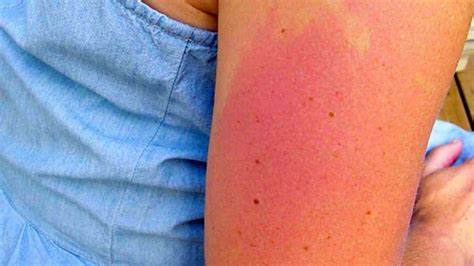 What Does Sun Allergy Rash Look Like? See These Pictures