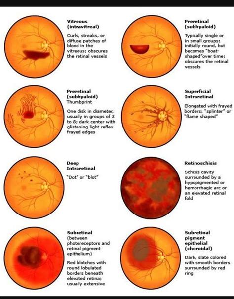 Fundoscopy different results diagram - www.anatomynote.com | Eye facts ...