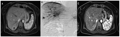 A 47-year-old woman with solitary liver metastasis in the right liver ...