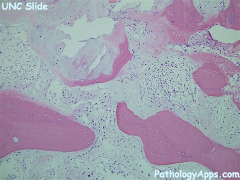 chondrosarcoma bone, soft tissue histology